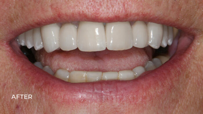 after porcelain crown veneers and whitening