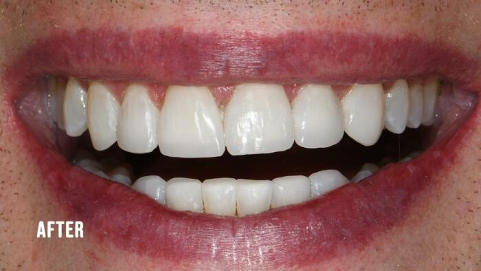 after whitening and cosmetic bonding